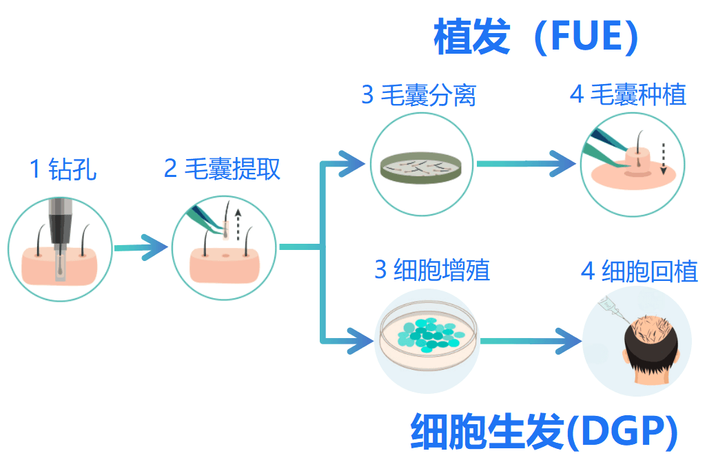 植发（FUE）与细胞生发（DGP）四步流程对比：从毛囊提取到种植/回植